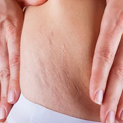 Stretch Marks Treatment